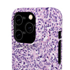 Slim Case Paraganglion