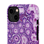 Slim Case Peutz-Jeghers Polyp