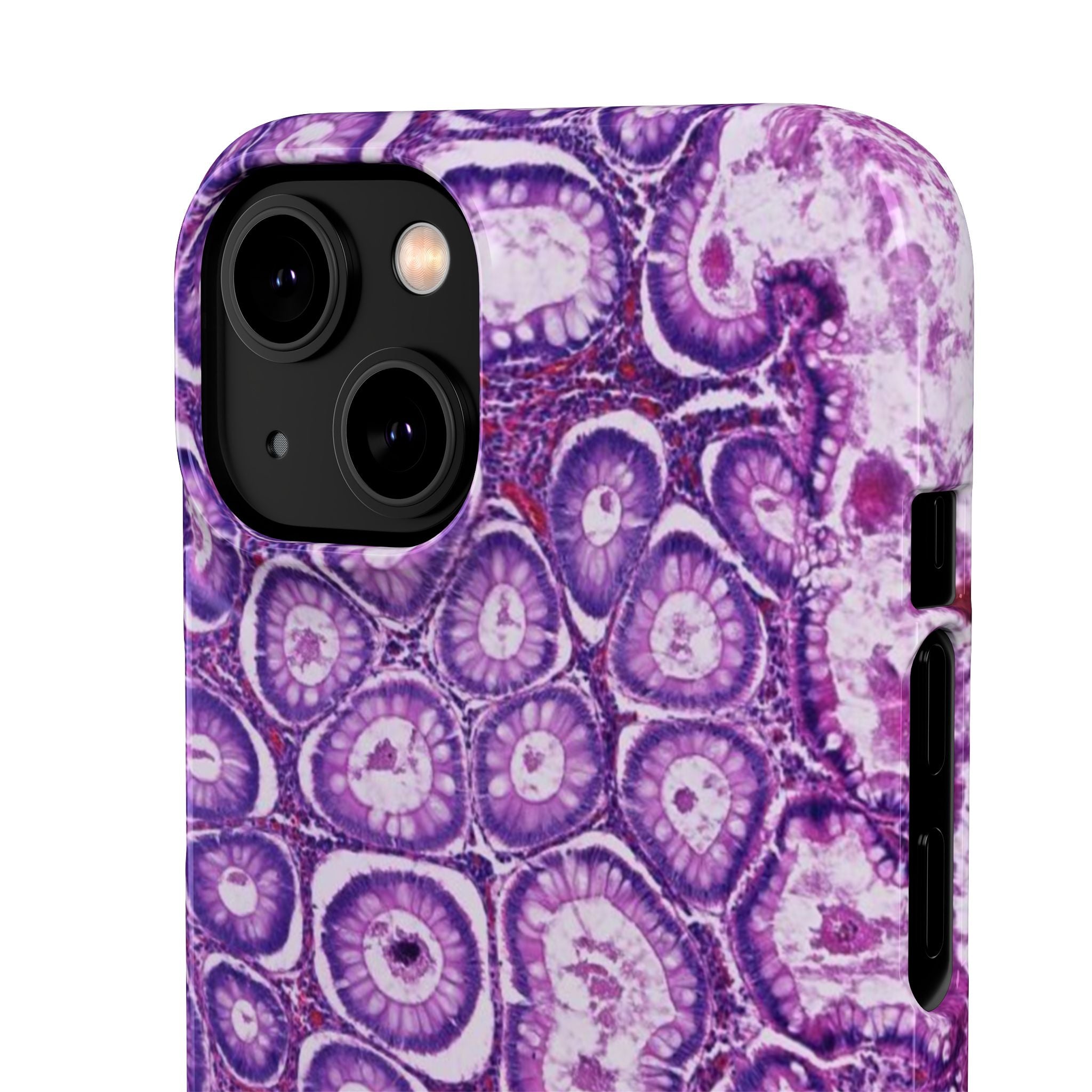 Slim Case Peutz-Jeghers Polyp