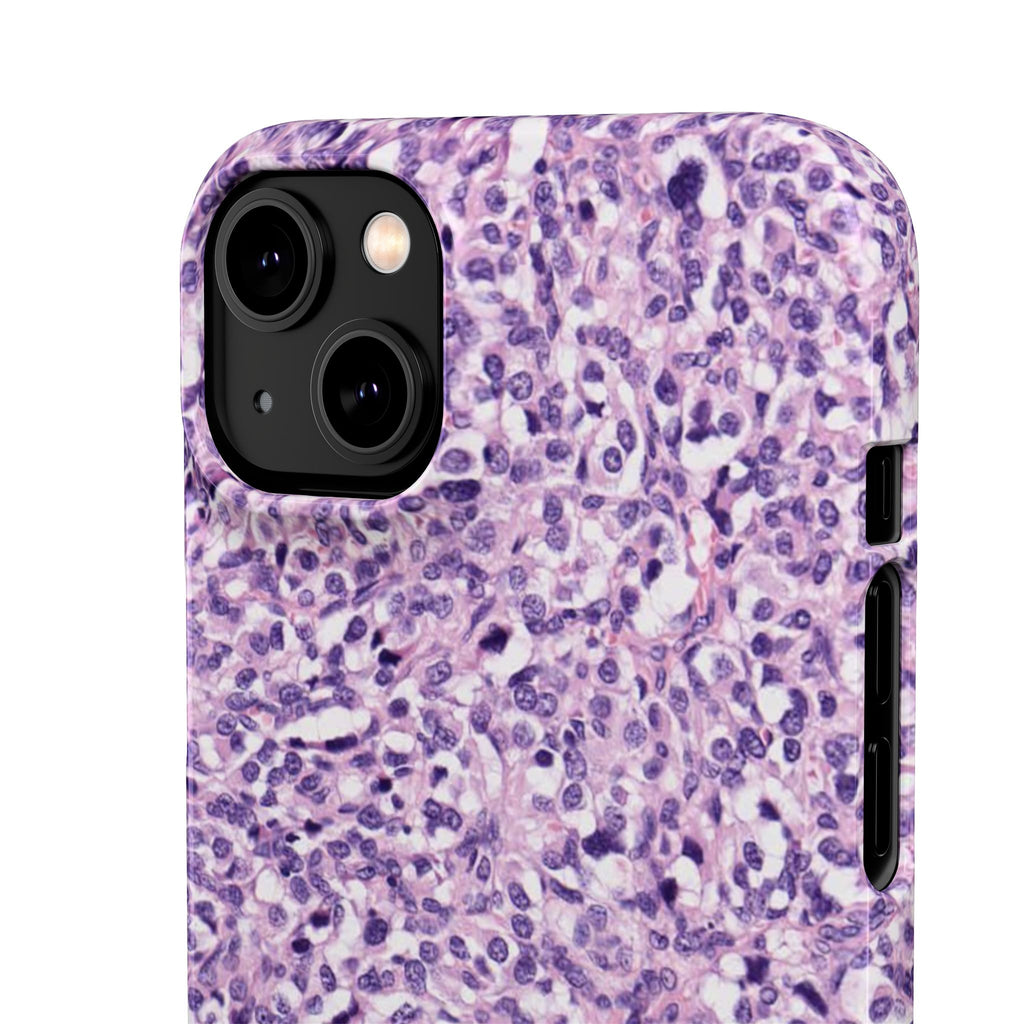 Slim Case Paraganglion