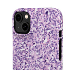 Slim Case Paraganglion