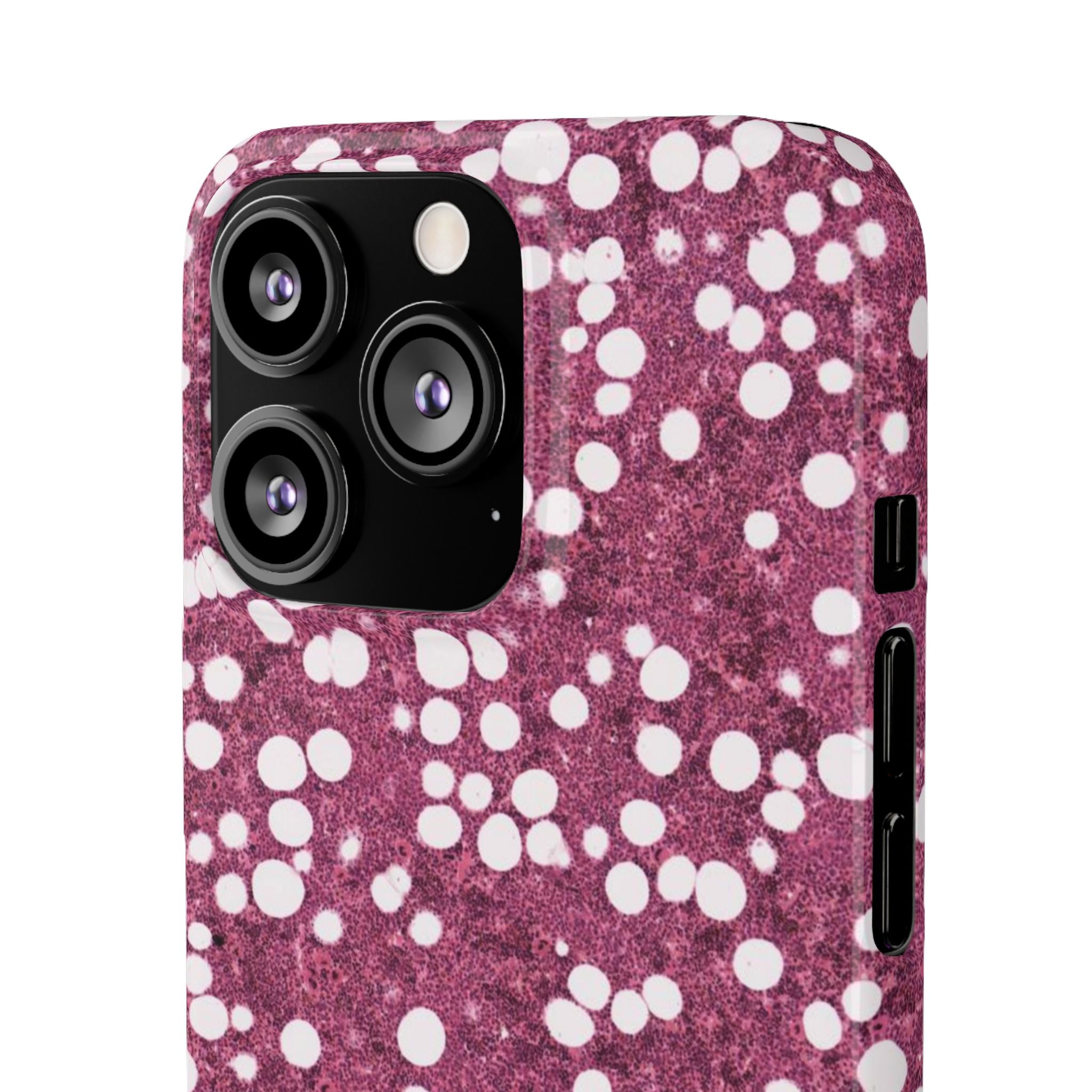 Slim Case Myelolipom