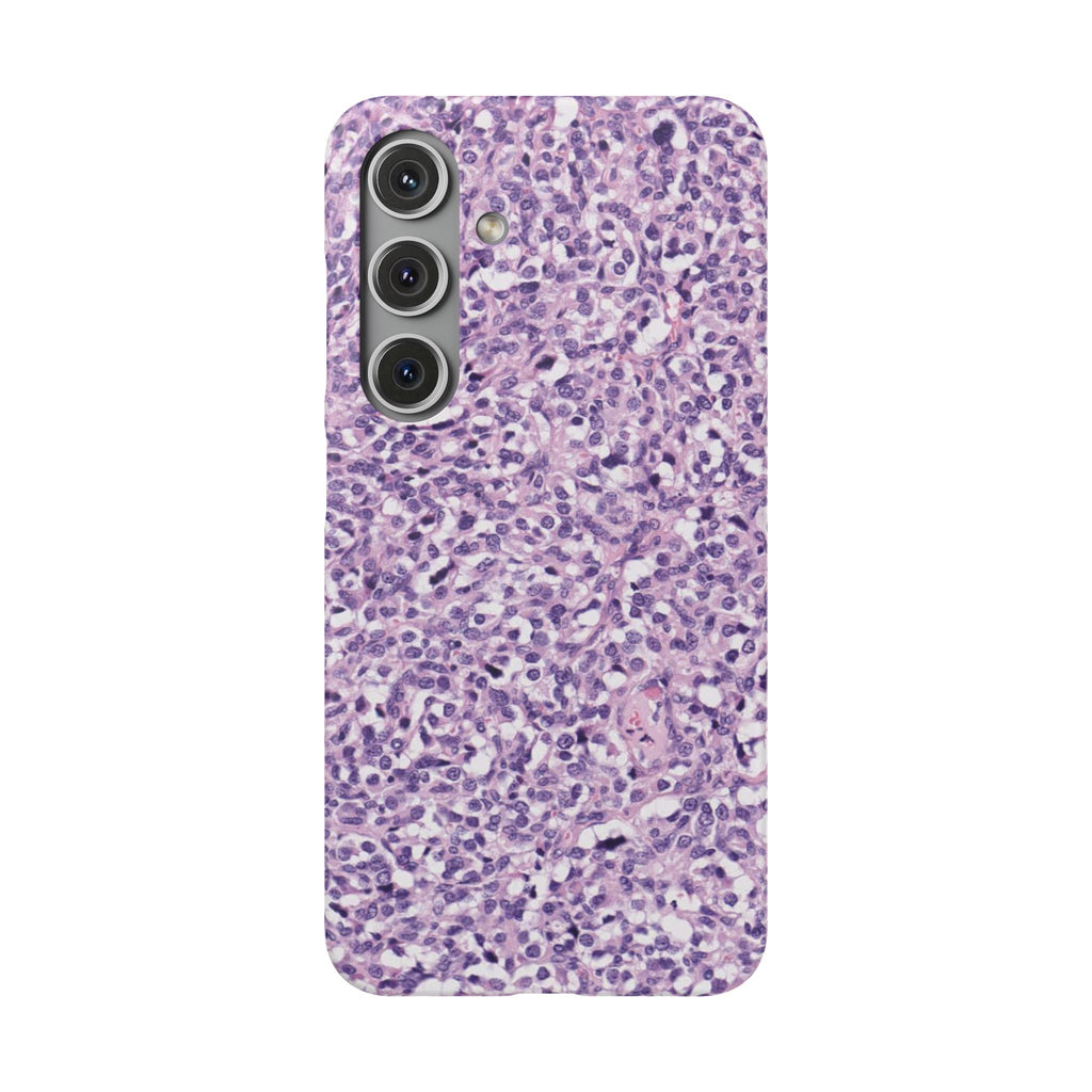 Slim Case Paraganglion