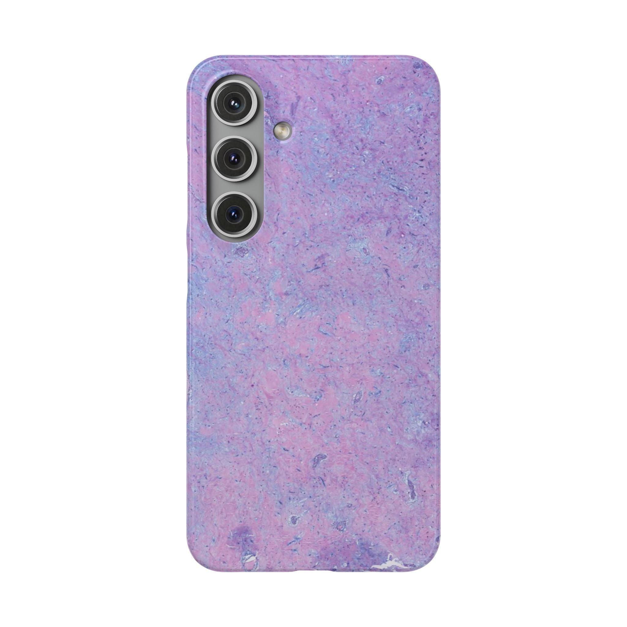 Slim Case Arterielles Myxom