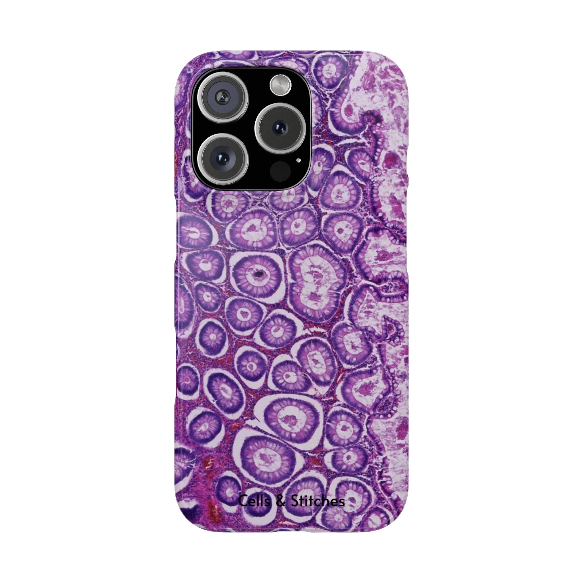 Slim Case Peutz-Jeghers Polyp