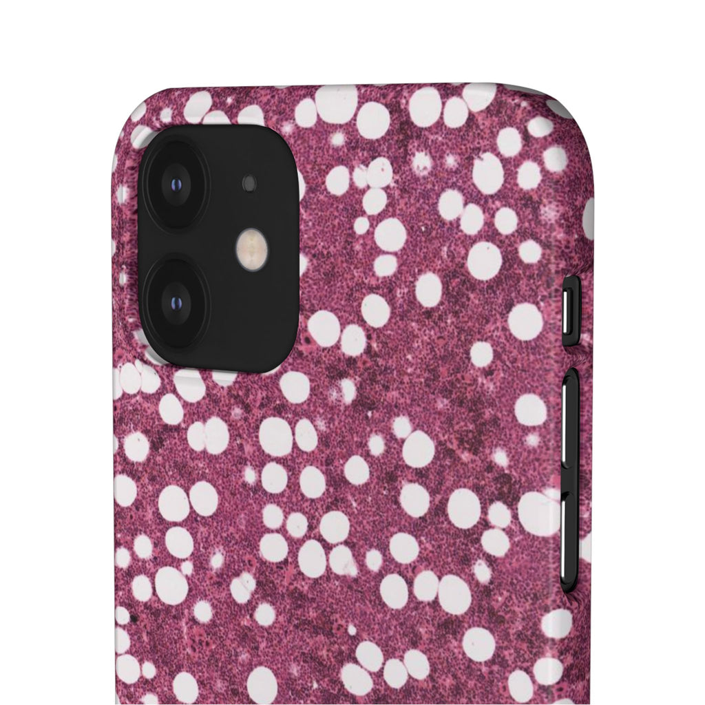 Slim Case Myelolipom