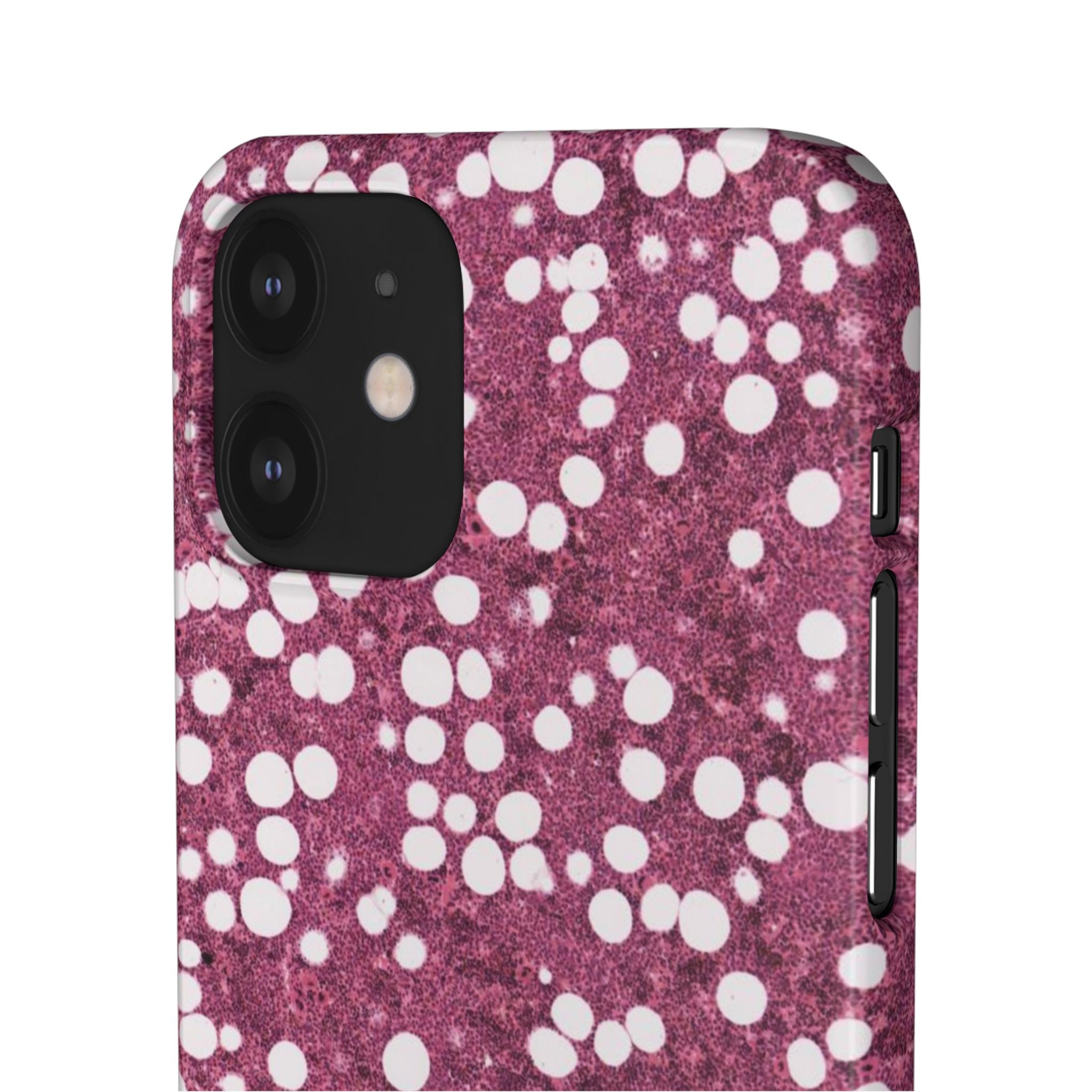 Slim Case Myelolipom