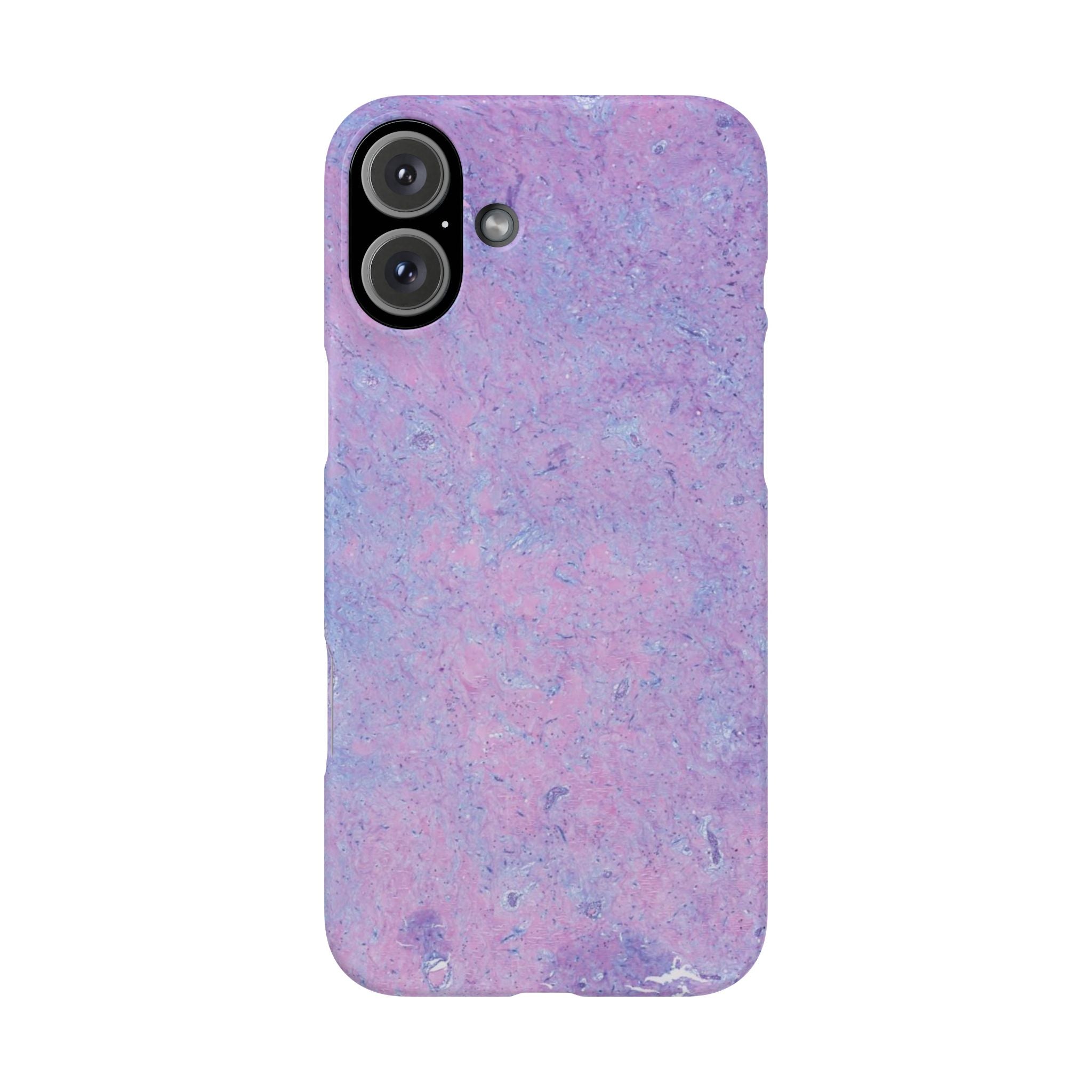 Slim Case Arterielles Myxom