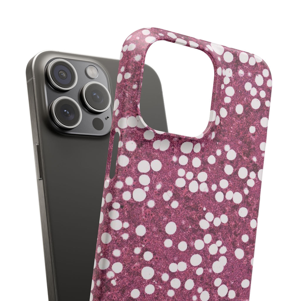 Slim Case Myelolipom
