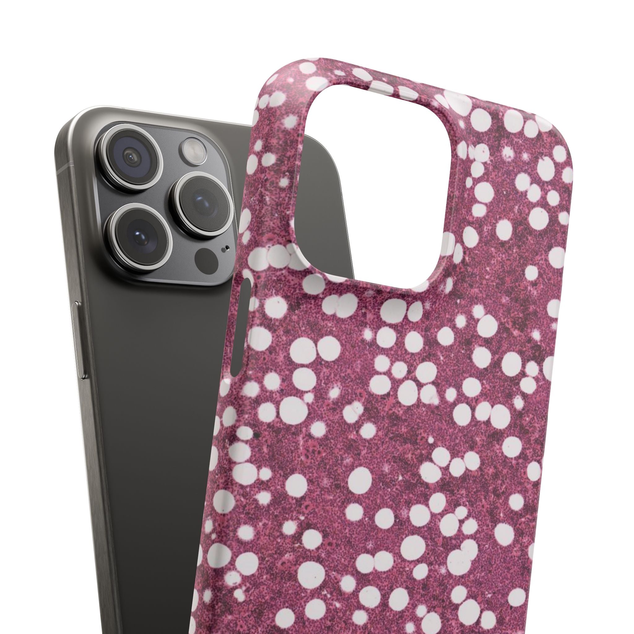 Slim Case Myelolipom
