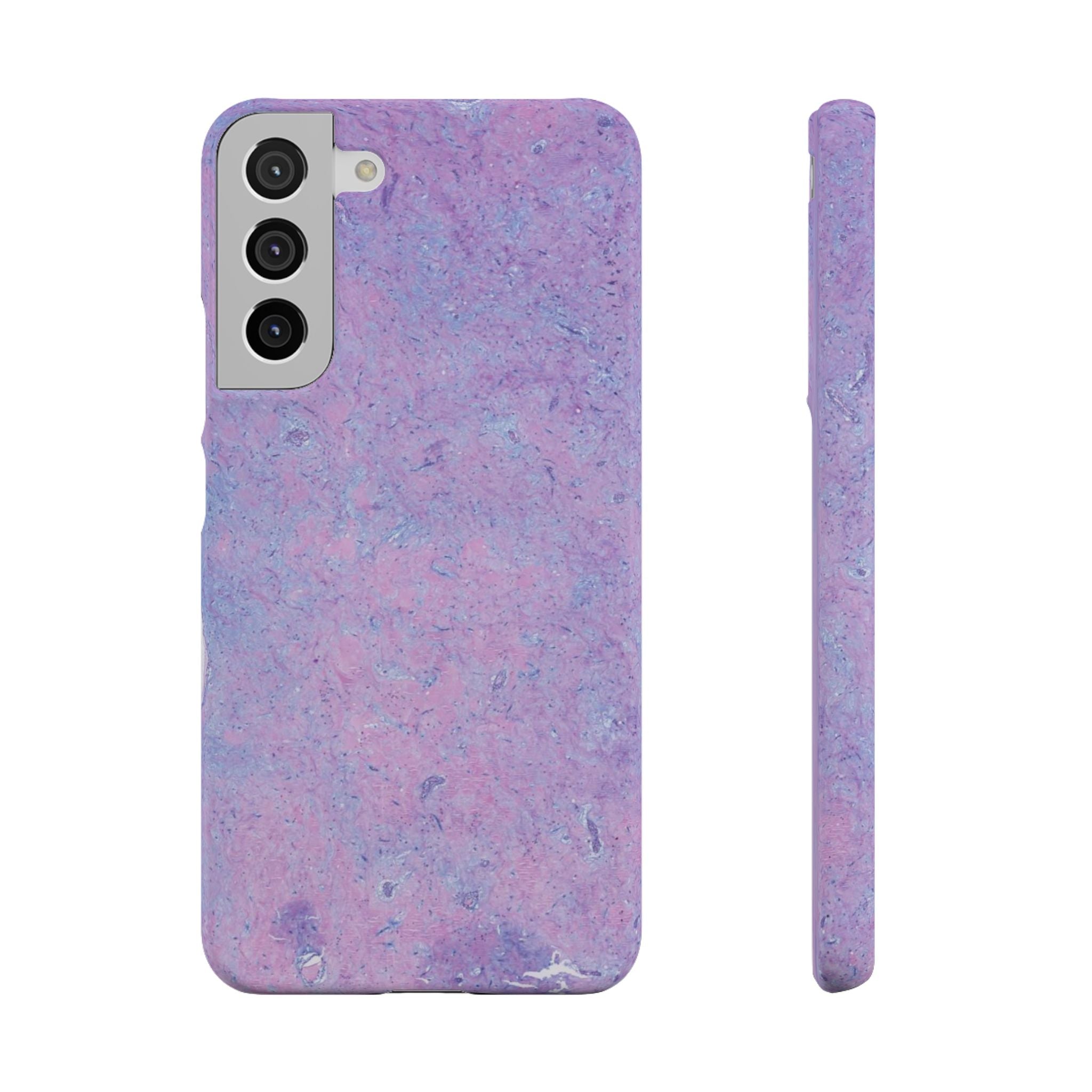 Slim Case Arterielles Myxom