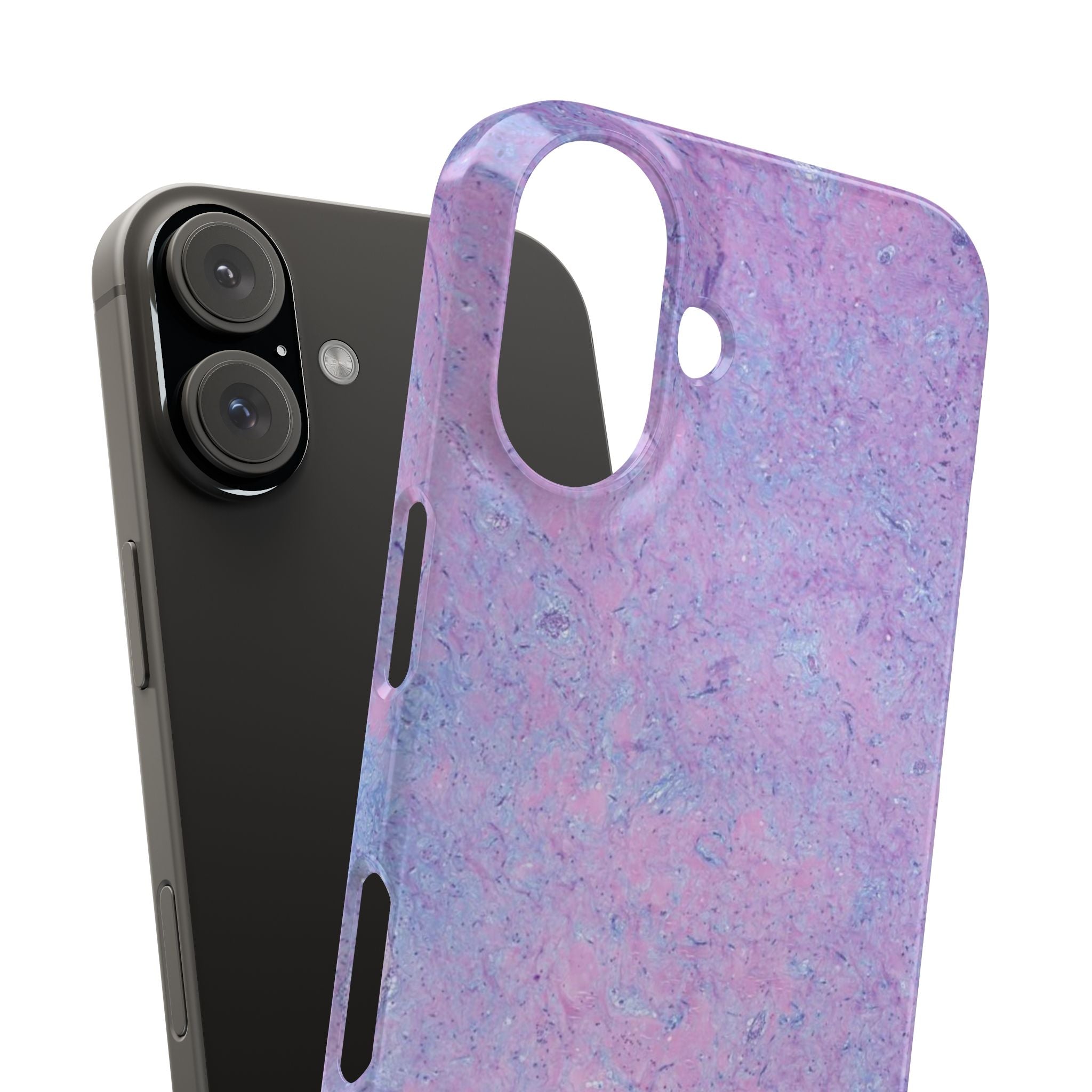 Slim Case Arterielles Myxom