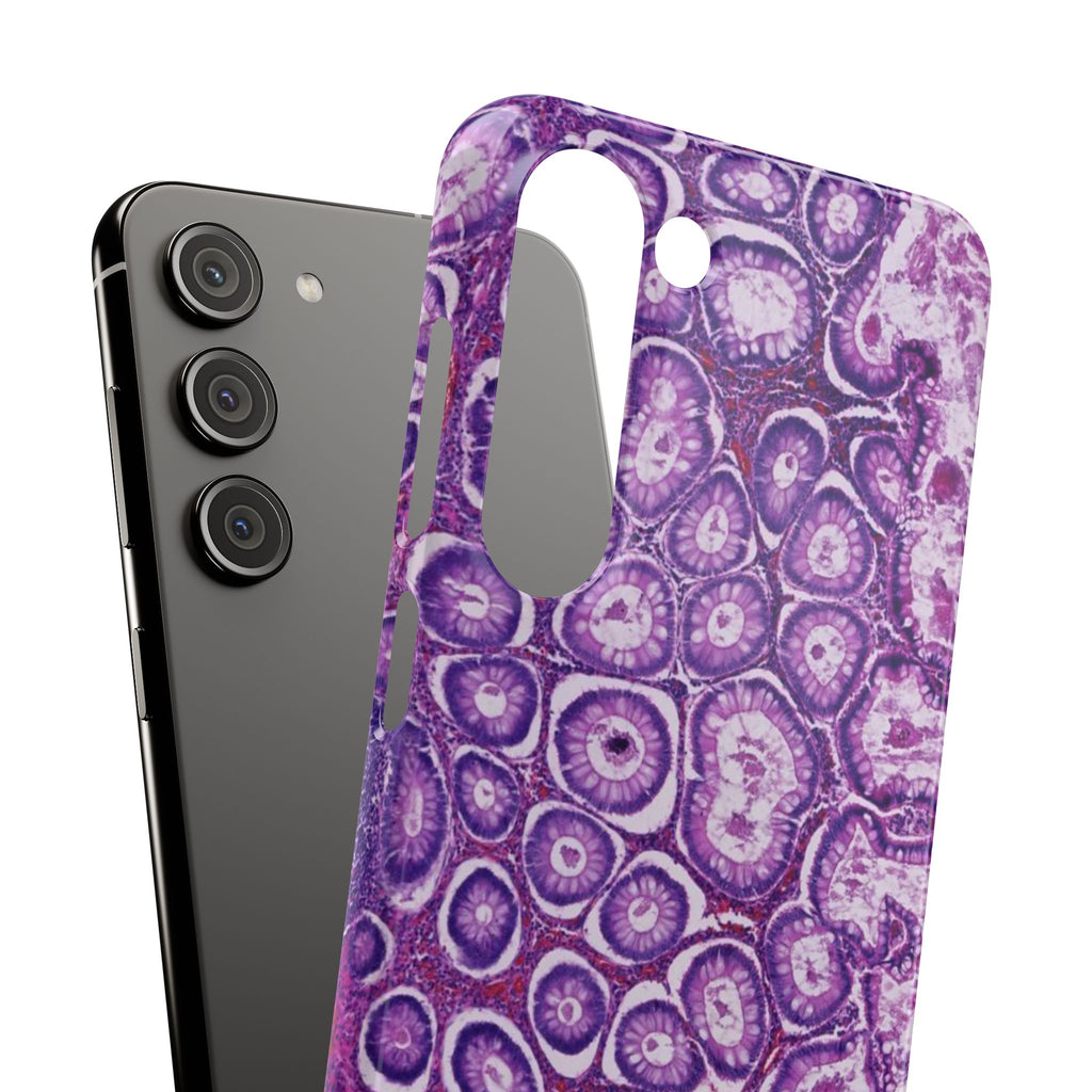 Slim Case Peutz-Jeghers Polyp