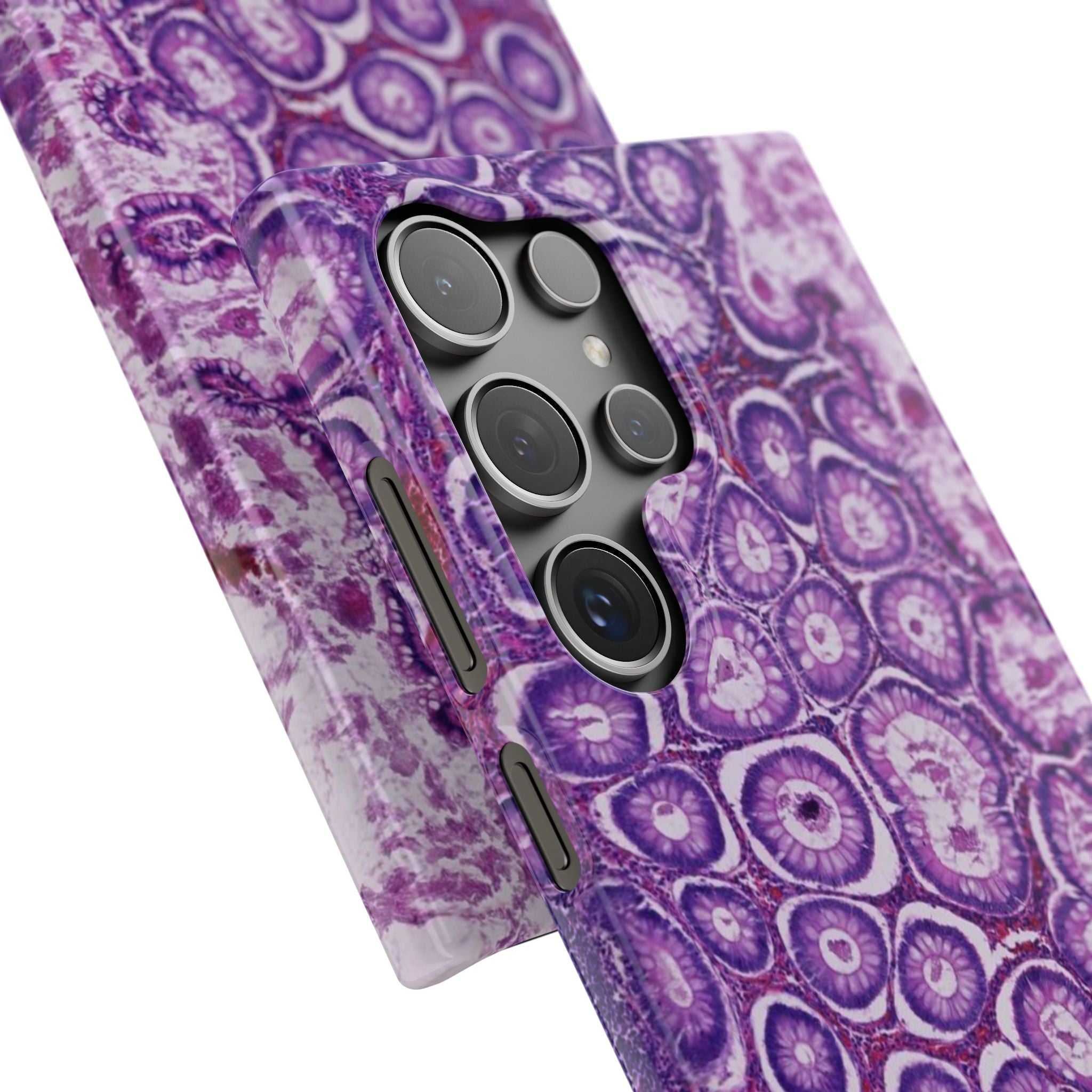 Slim Case Peutz-Jeghers Polyp