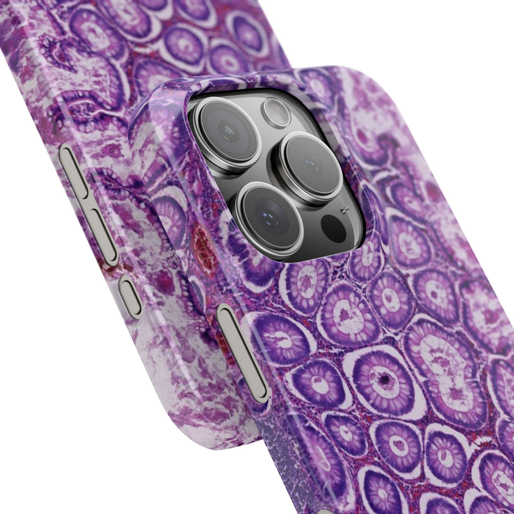 Slim Case Peutz-Jeghers Polyp