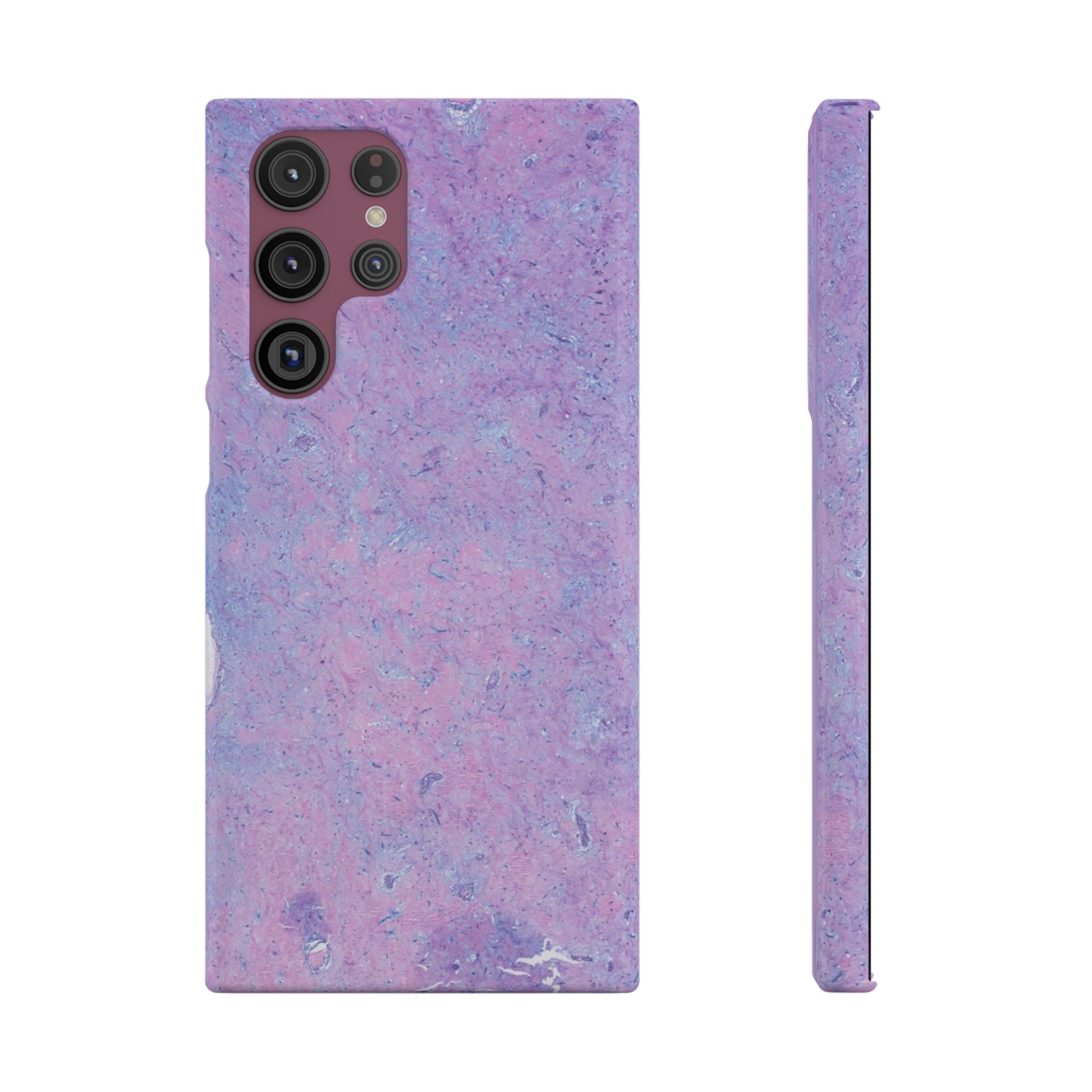 Slim Case Arterielles Myxom
