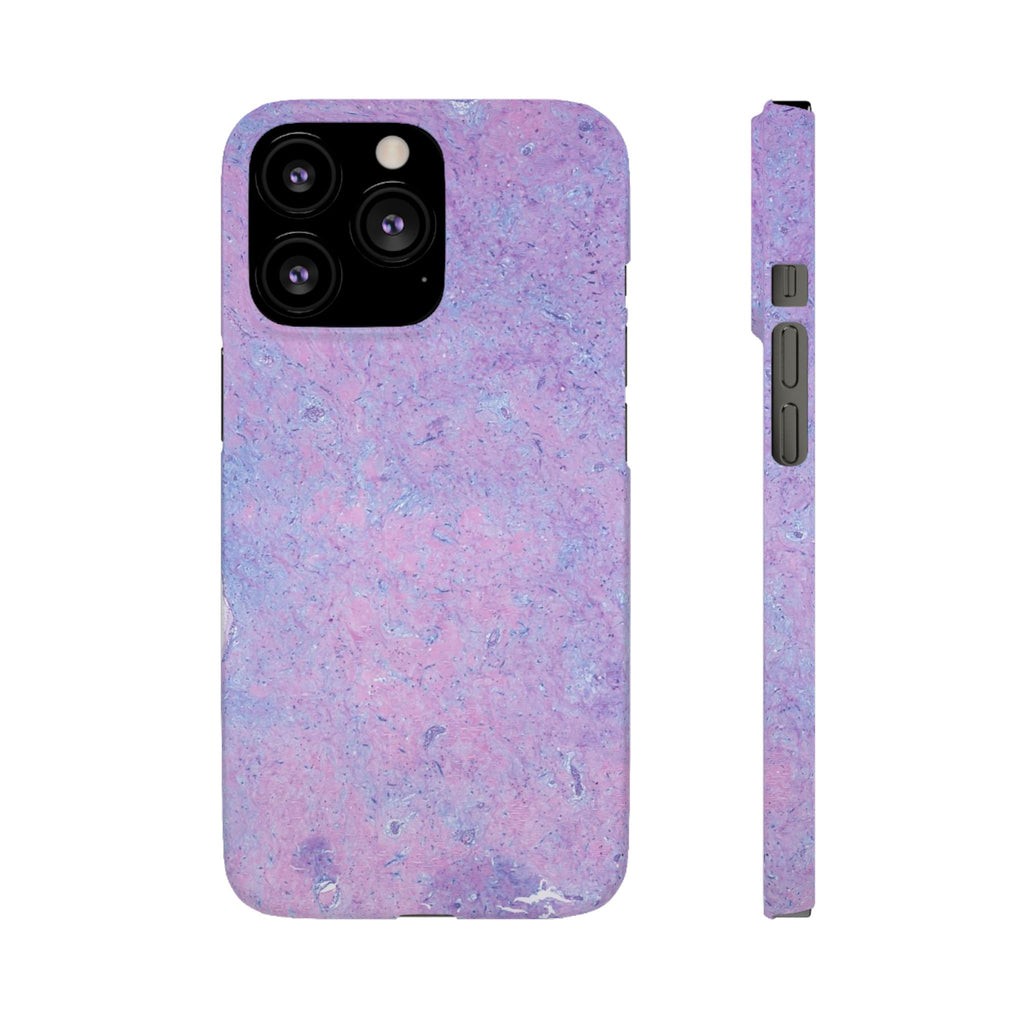 Slim Case Arterielles Myxom