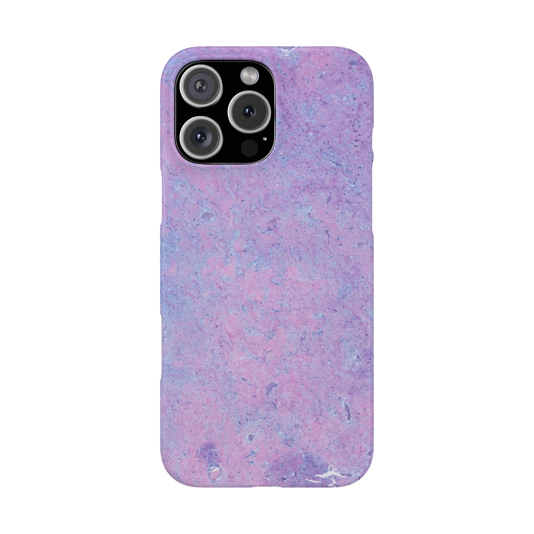 Slim Case Arterielles Myxom