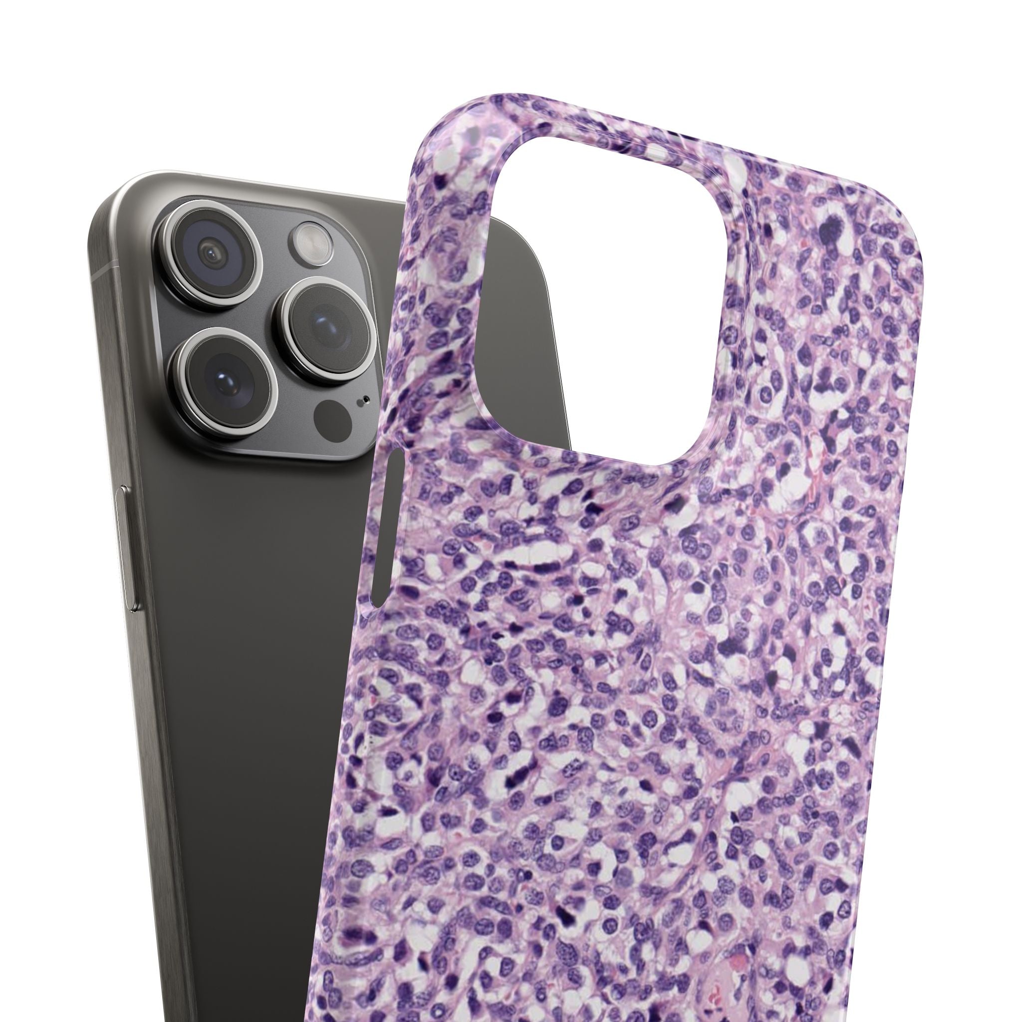 Slim Case Paraganglion