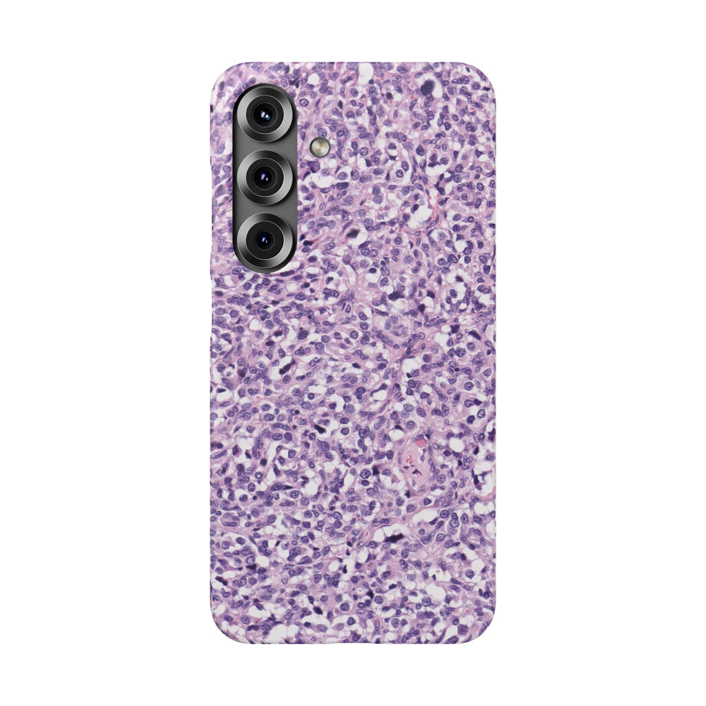 Slim Case Paraganglion