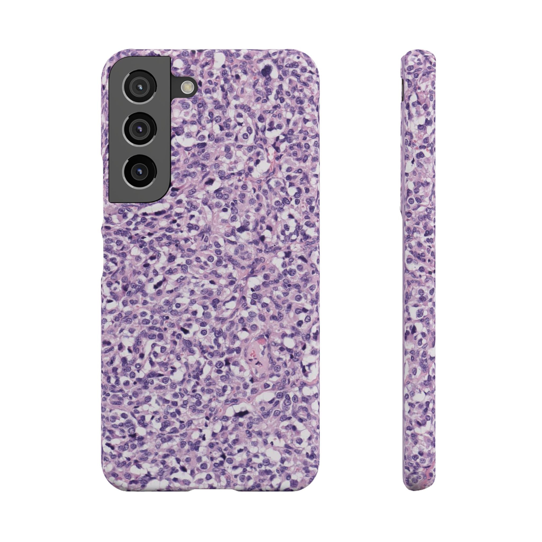 Slim Case Paraganglion