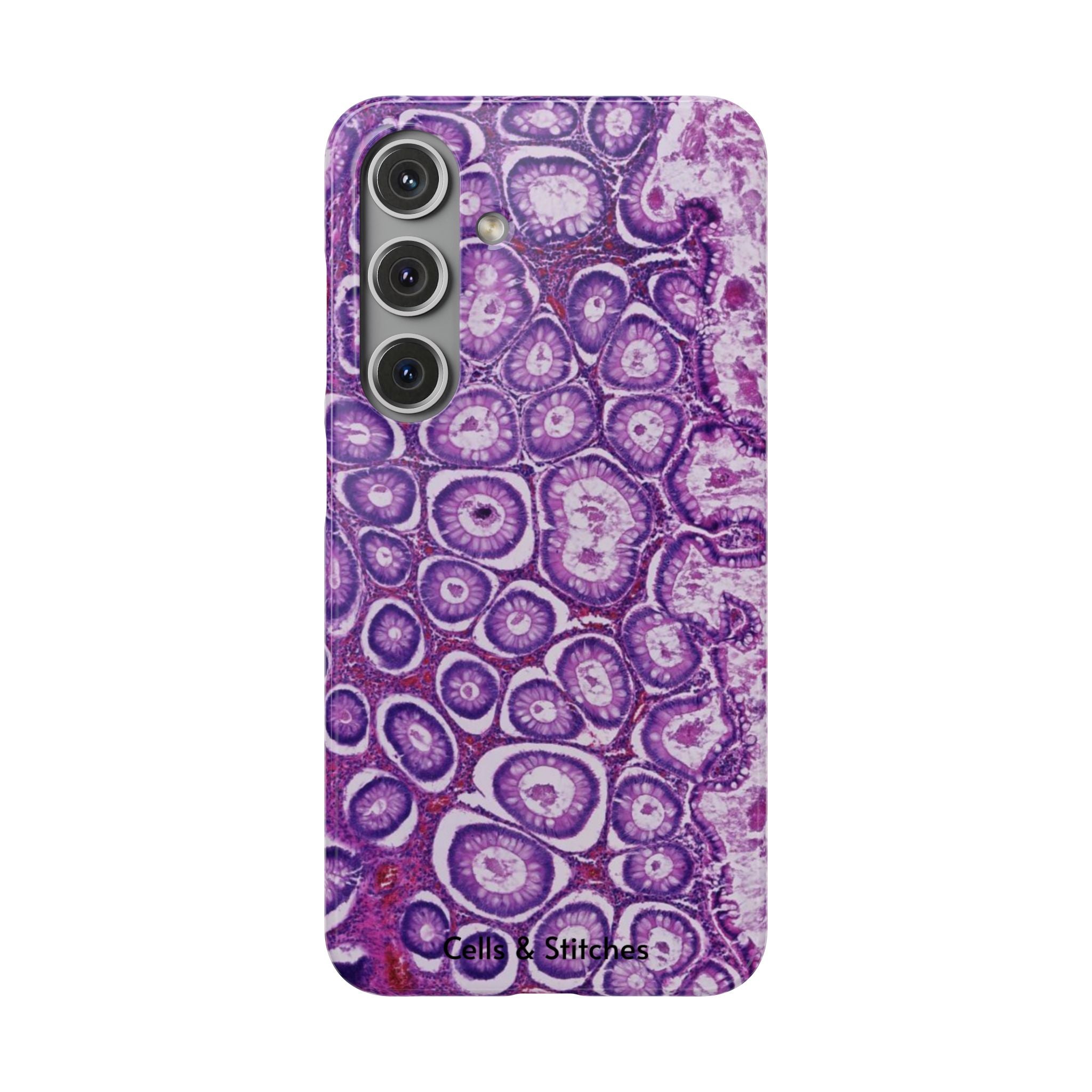 Slim Case Peutz-Jeghers Polyp