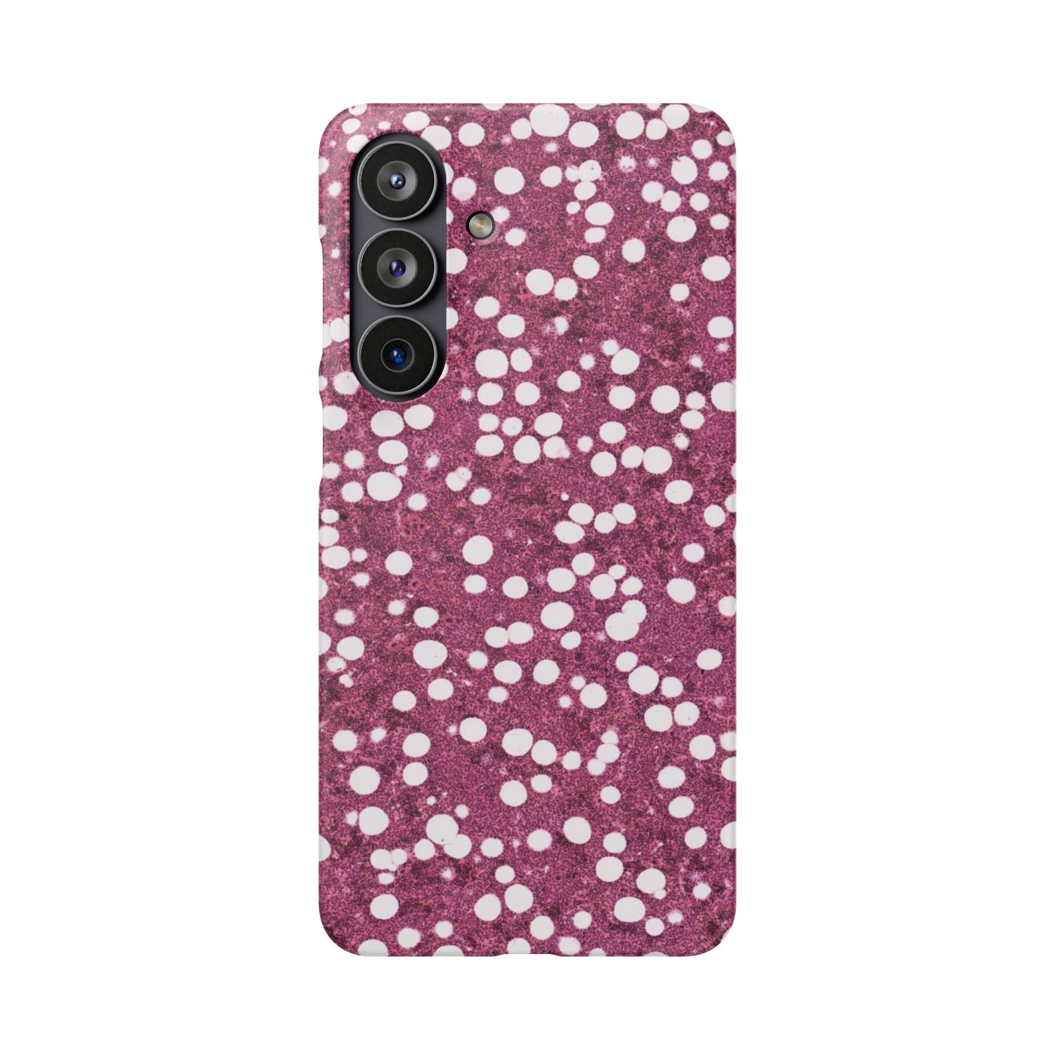 Slim Case Myelolipom