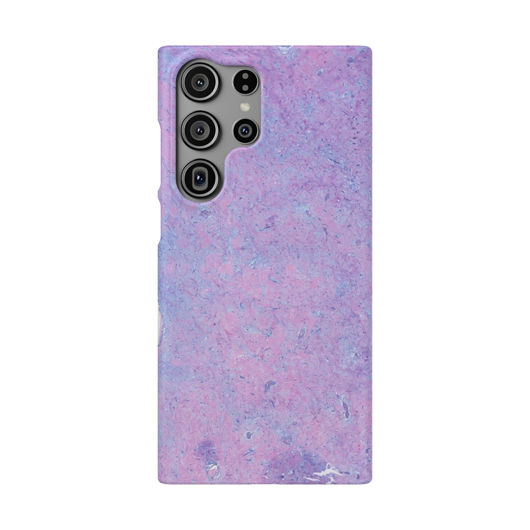 Slim Case Arterielles Myxom