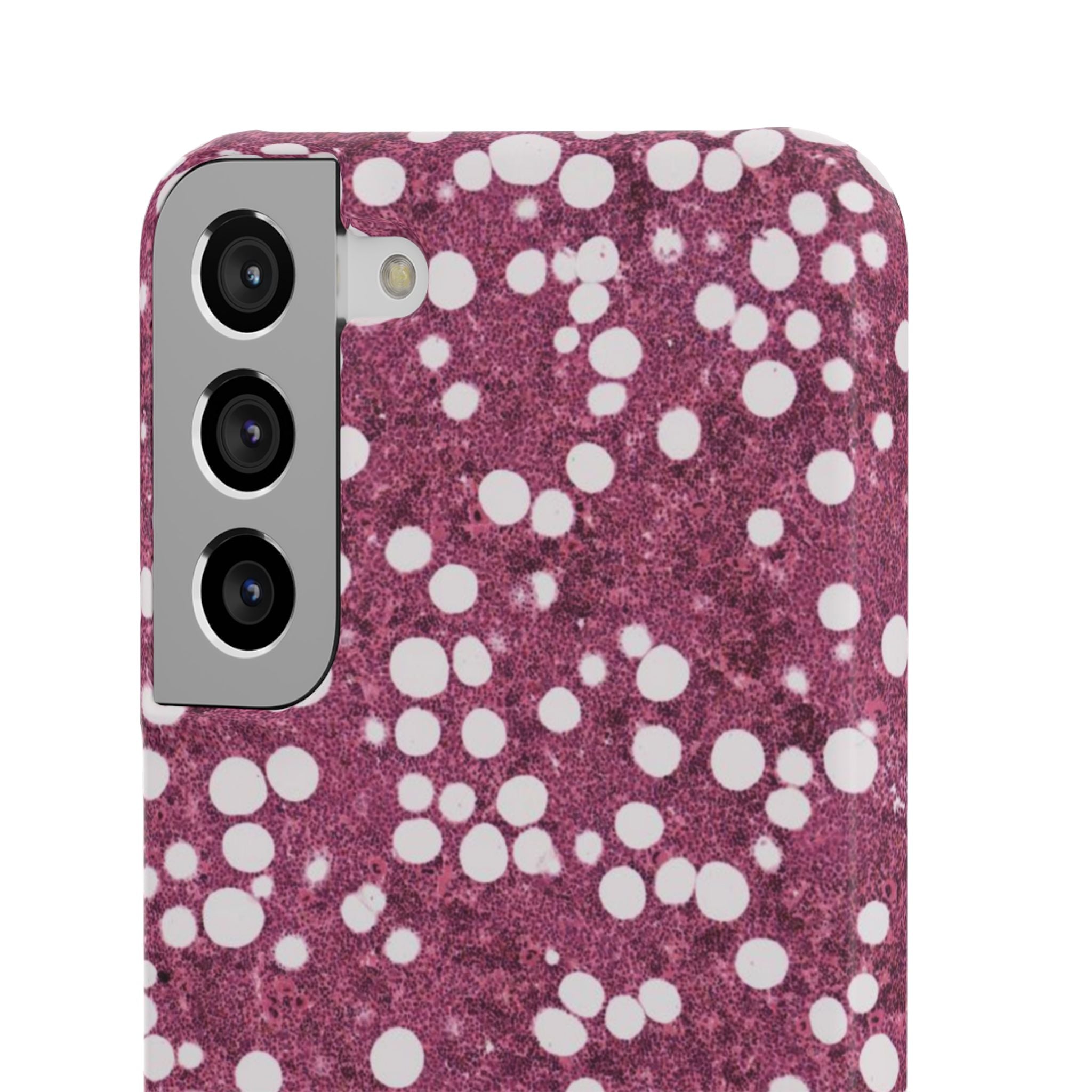 Slim Case Myelolipom