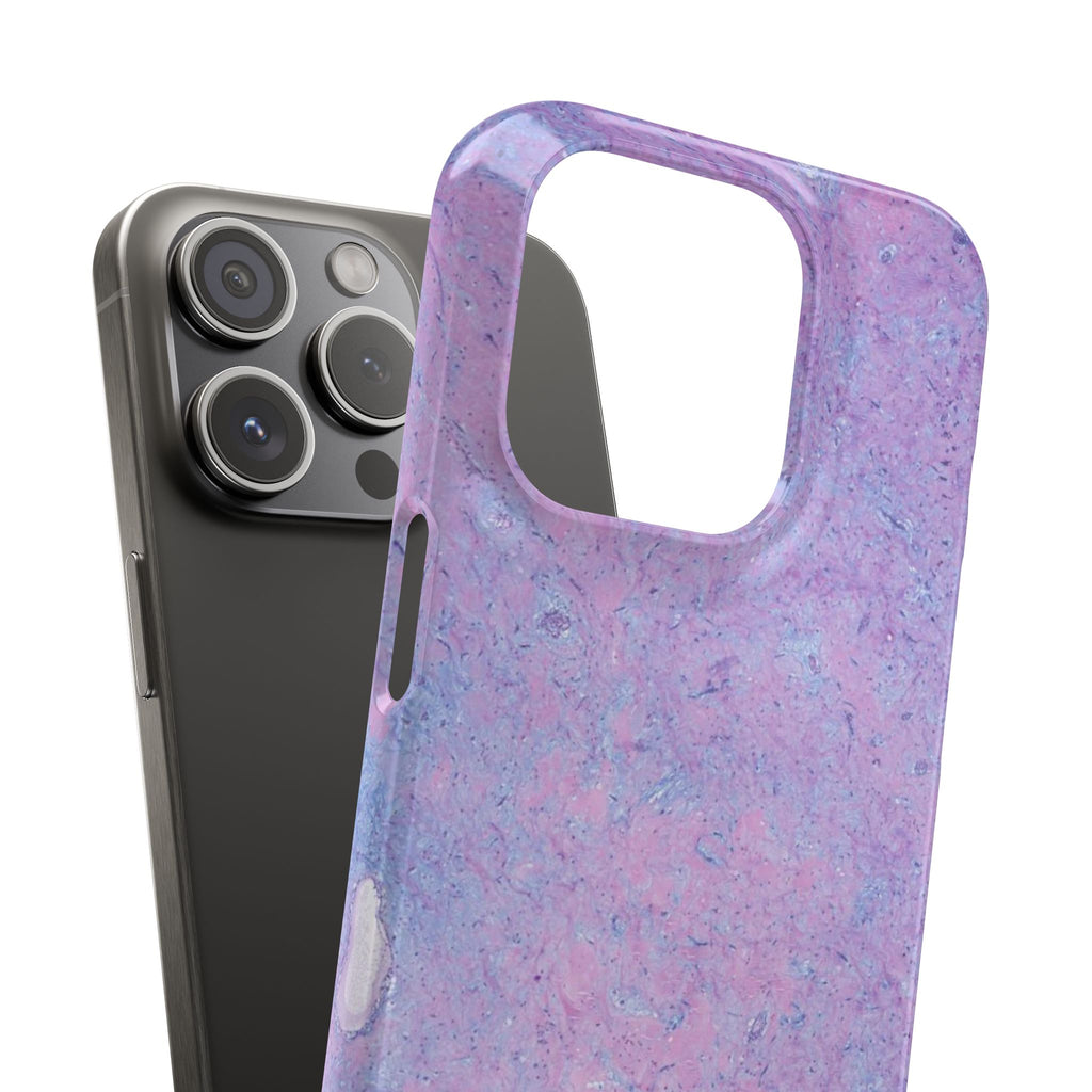 Slim Case Arterielles Myxom