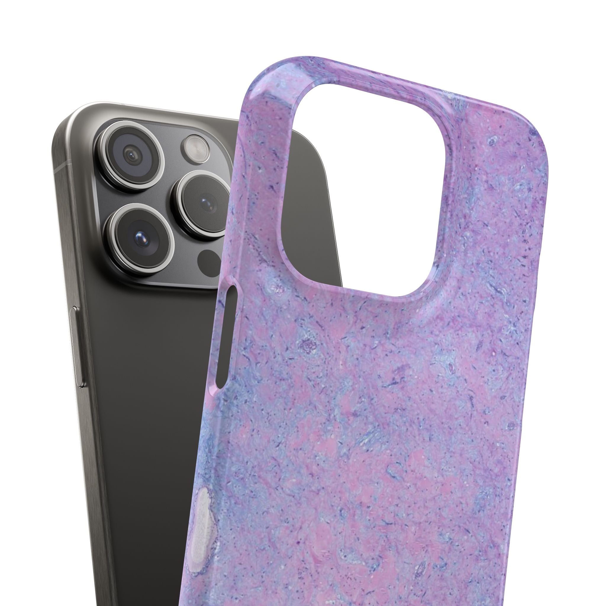 Slim Case Arterielles Myxom