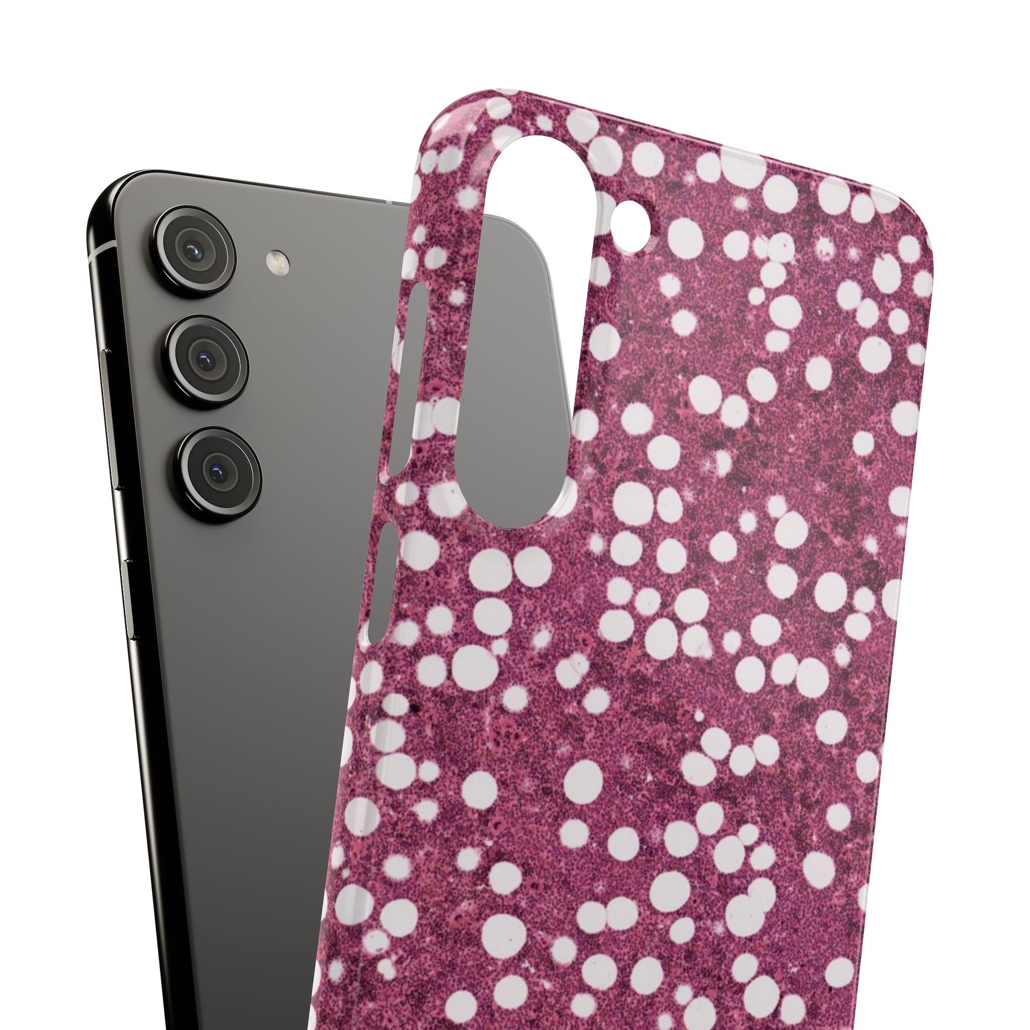 Slim Case Myelolipom