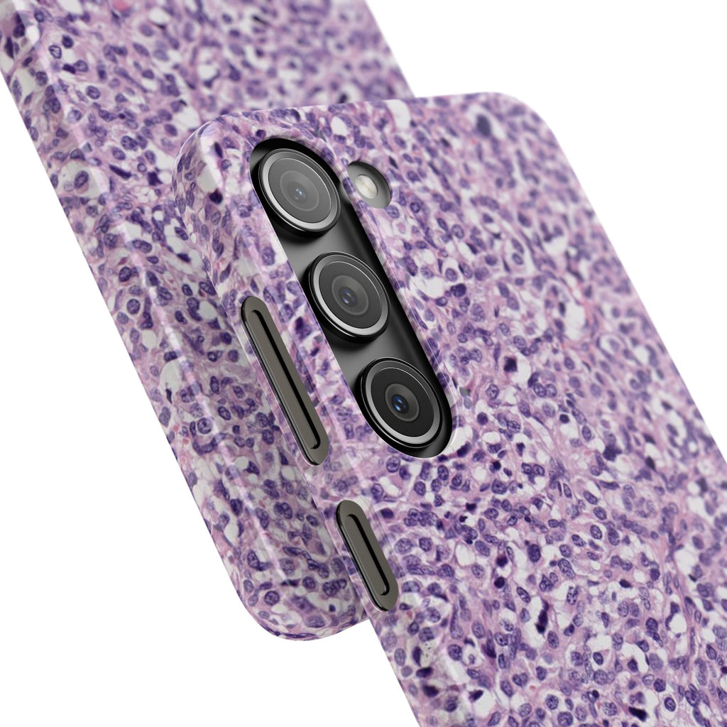 Slim Case Paraganglion