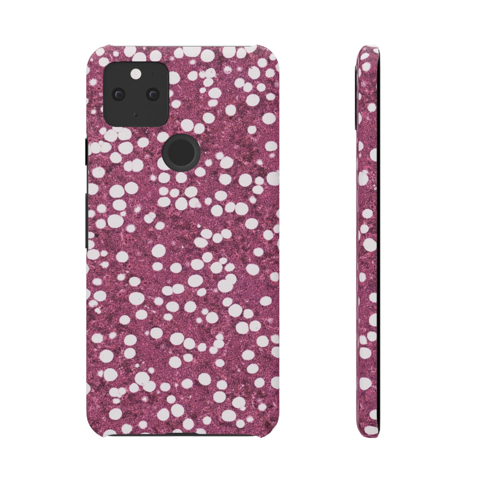 Slim Case Myelolipom