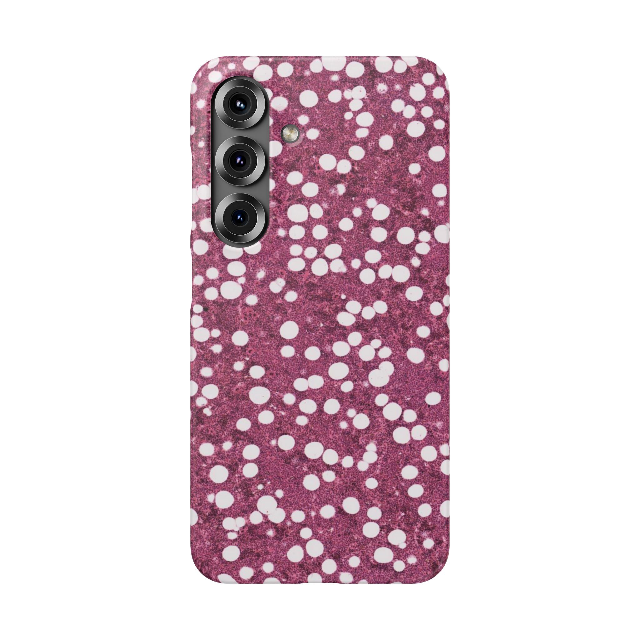 Slim Case Myelolipom