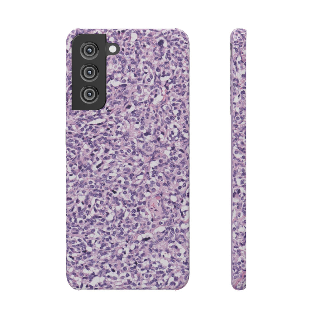 Slim Case Paraganglion
