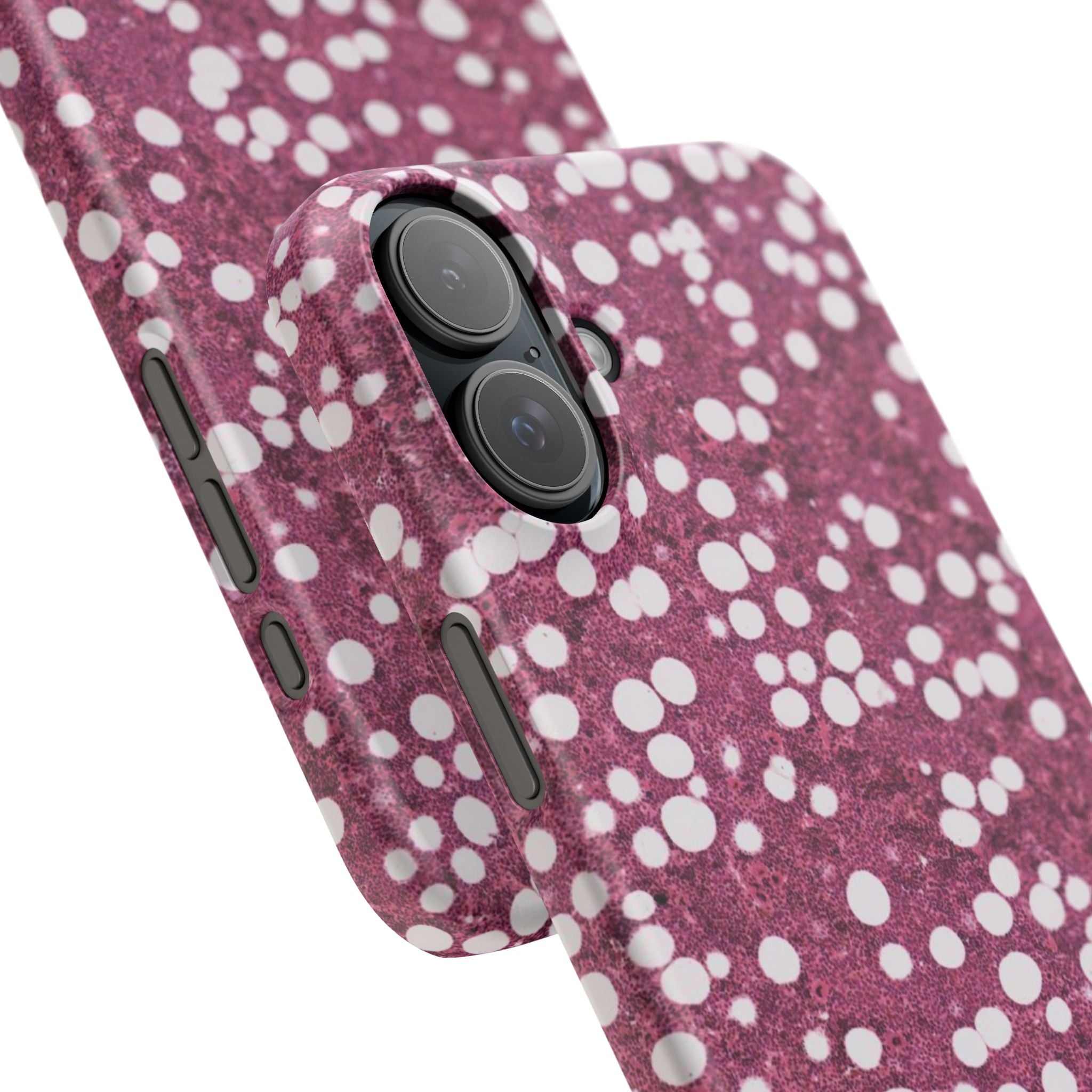 Slim Case Myelolipom