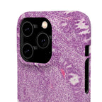 Slim Case Endometrium