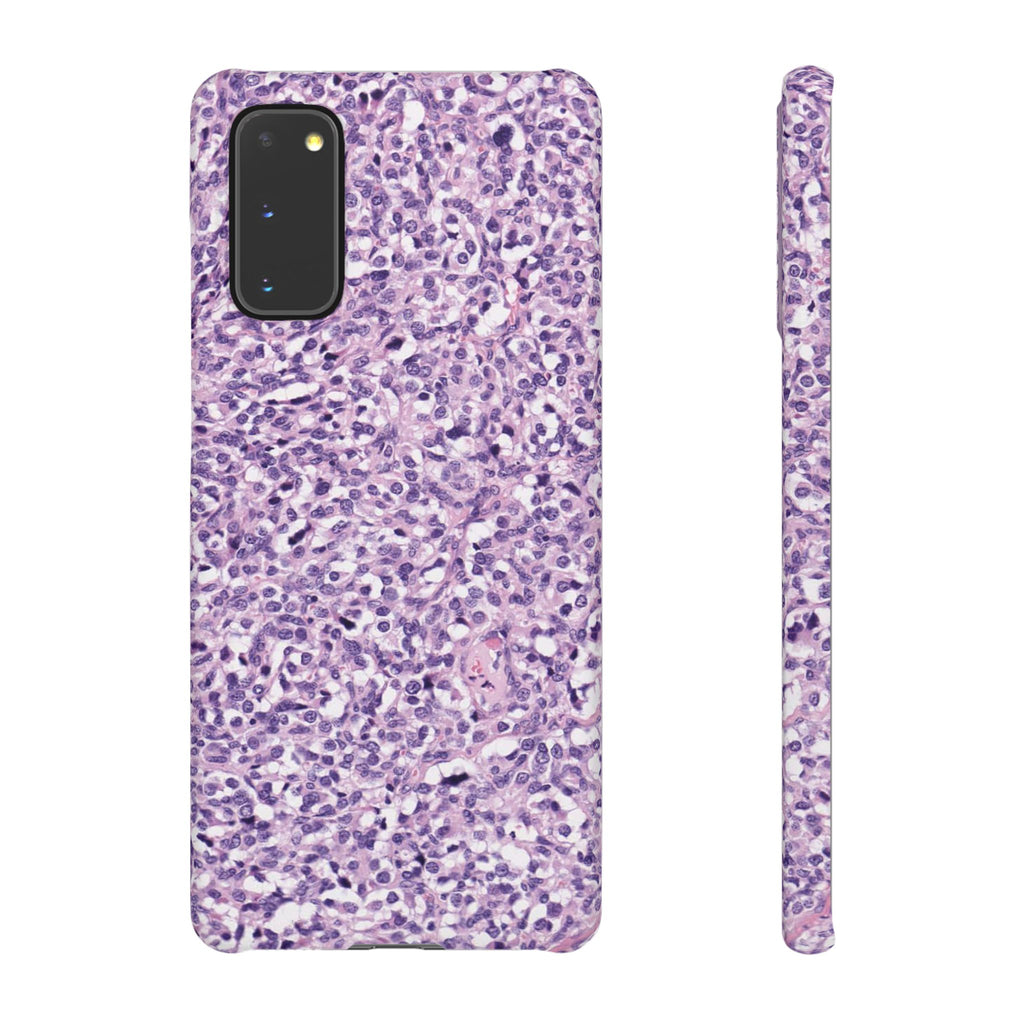 Slim Case Paraganglion