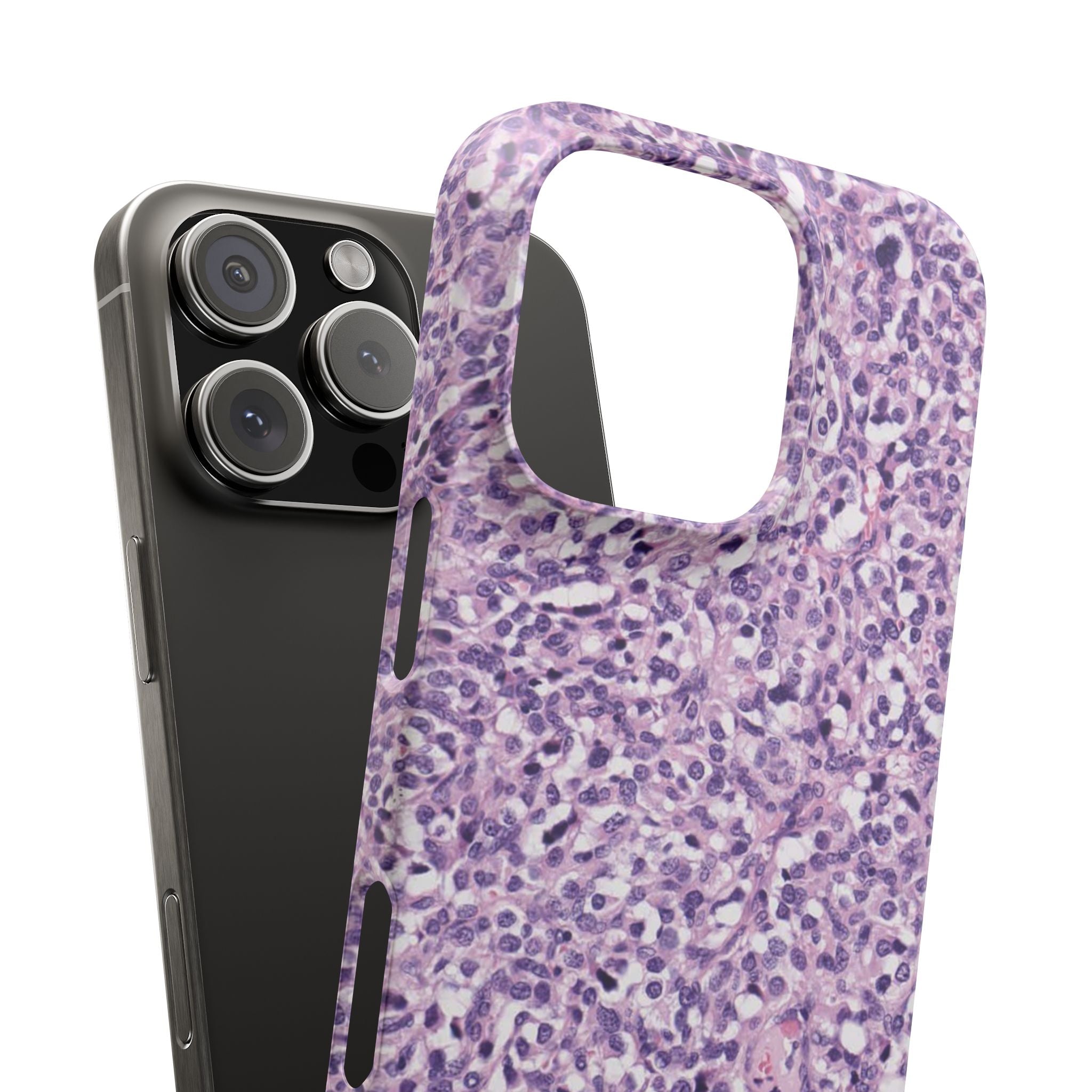 Slim Case Paraganglion