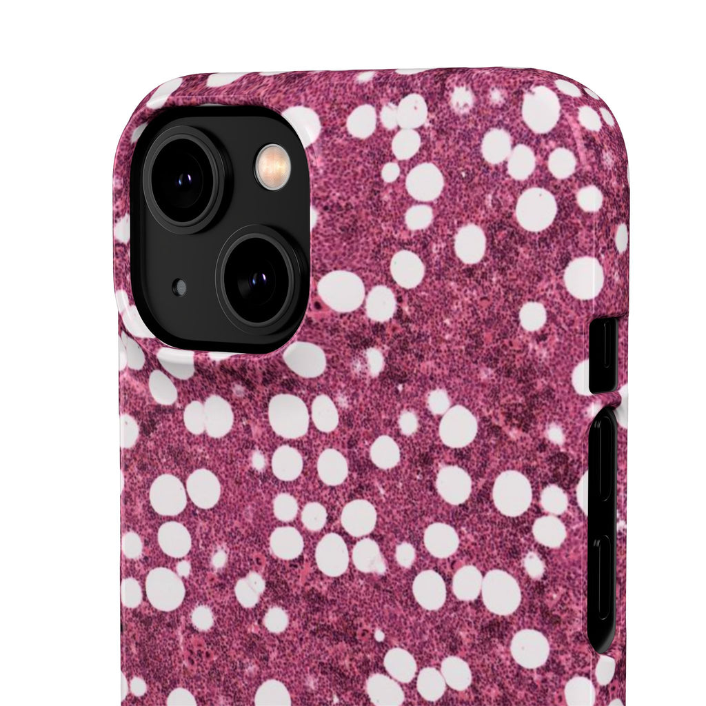 Slim Case Myelolipom