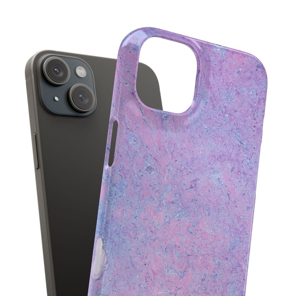 Slim Case Arterielles Myxom
