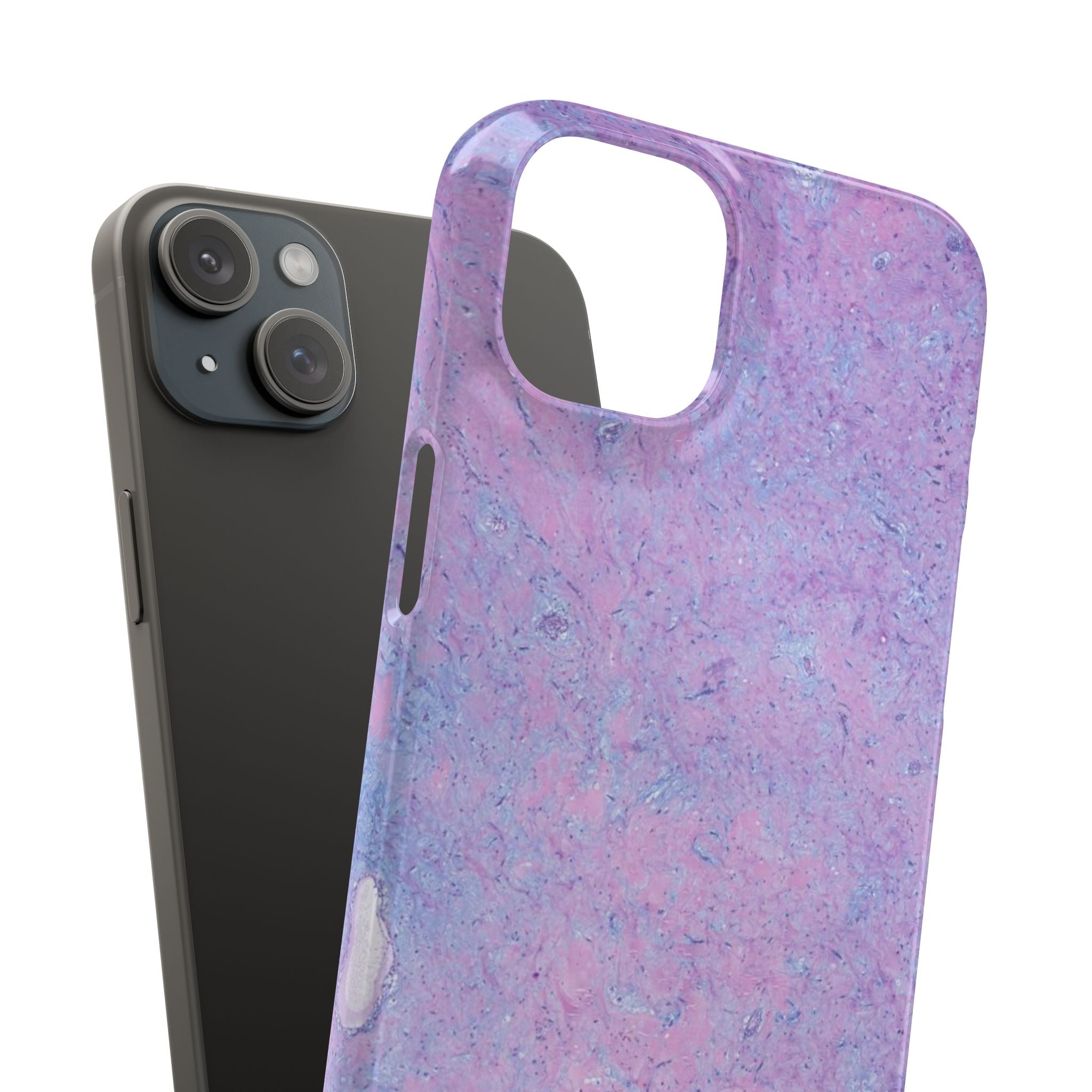 Slim Case Arterielles Myxom