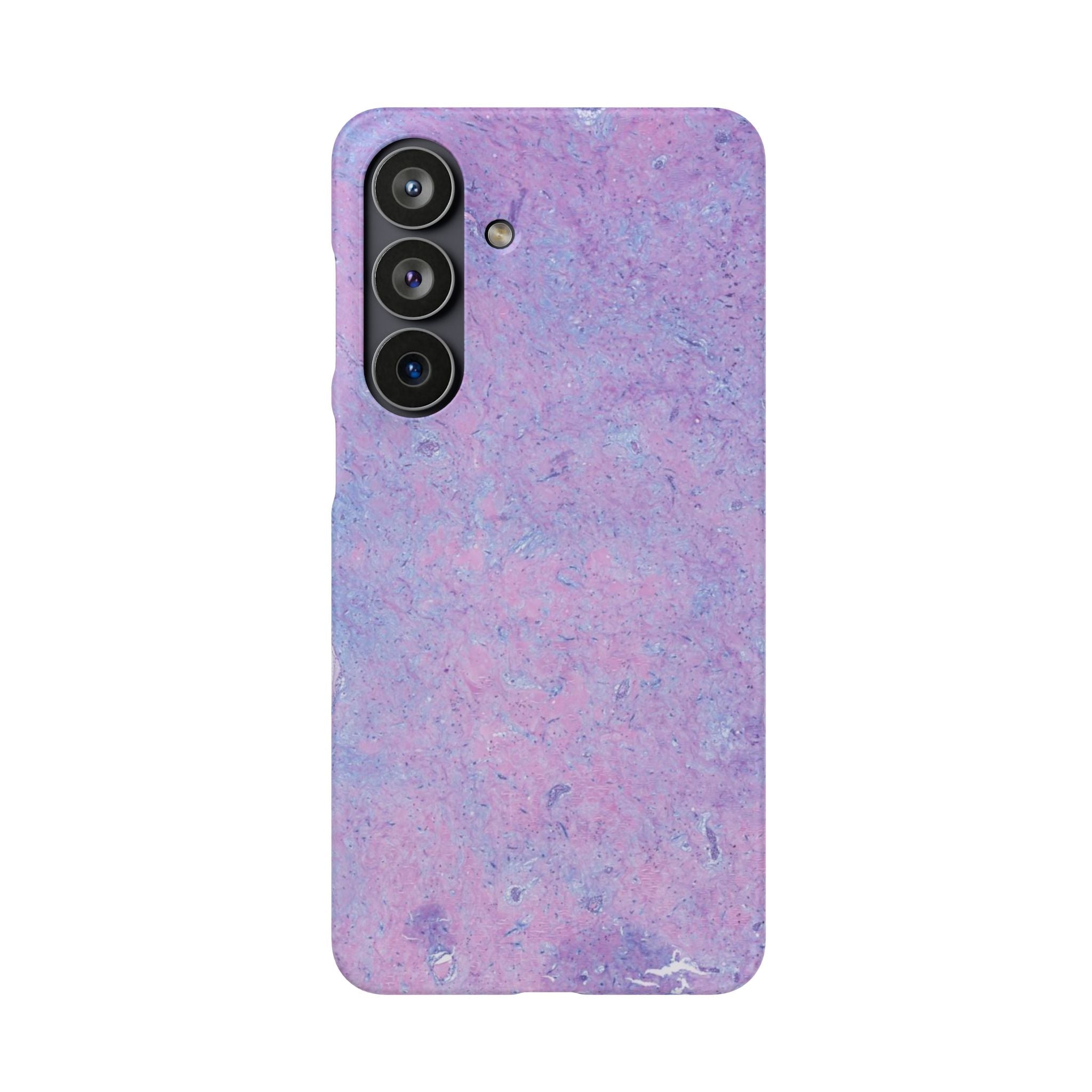 Slim Case Arterielles Myxom