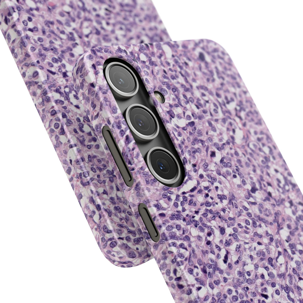 Slim Case Paraganglion