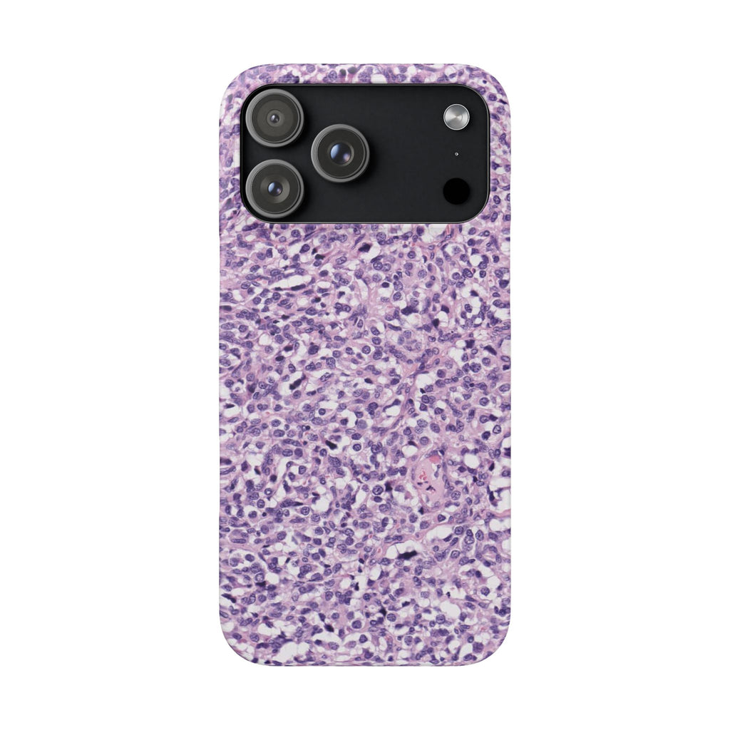 Slim Case Paraganglion