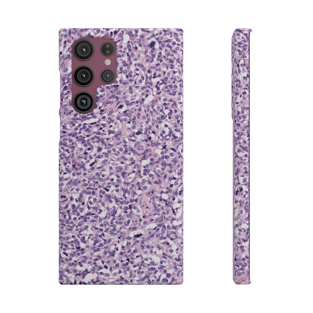 Slim Case Paraganglion